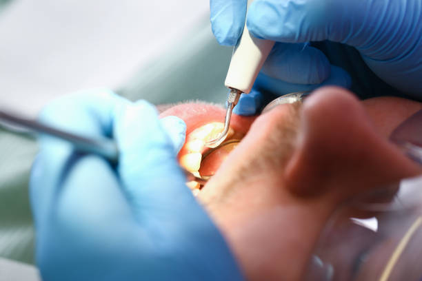 Best Urgent Care for Lost Fillings or Crowns in Royal Oak, MI